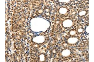 The image on the left is immunohistochemistry of paraffin-embedded Human thyroid cancer tissue using ABIN7131276(SYT7 Antibody) at dilution 1/15, on the right is treated with fusion protein. (SYT7 antibody)