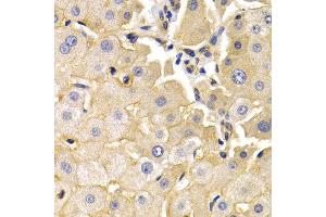 Immunohistochemistry of paraffin-embedded human liver cancer using KLKB1 antibody at dilution of 1:200 (400x lens).
