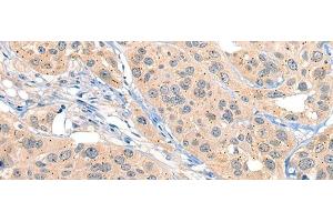 Immunohistochemistry of paraffin-embedded Human esophagus cancer tissue using MIIP Polyclonal Antibody at dilution of 1:45(x200) (MIIP antibody)