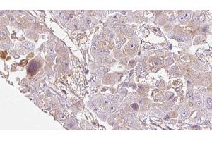 ABIN6272714 at 1/100 staining Human liver cancer tissue by IHC-P. (OR1E1 antibody  (C-Term))