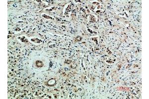 Immunohistochemical analysis of paraffin-embedded human-breast-cancer, antibody was diluted at 1:200