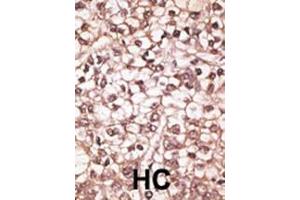 Formalin-fixed and paraffin-embedded human cancer tissue reacted with the primary antibody, which was peroxidase-conjugated to the secondary antibody, followed by AEC staining. (ABCB4 antibody  (AA 624-654))