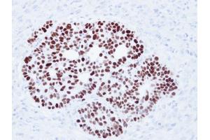 IHC-P Image Immunohistochemical analysis of paraffin-embedded Cal27 xenograft, using p53, antibody at 1:500 dilution. (p53 antibody)