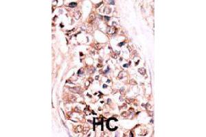 Formalin-fixed and paraffin-embedded human hepatocellular carcinoma tissue reacted with DUSP14 polyclonal antibody  , which was peroxidase-conjugated to the secondary antibody, followed by AEC staining. (DUSP14 antibody  (N-Term))