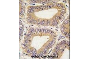 Formalin-fixed and paraffin-embedded human colon carcinoma tissue reacted with PHB2 Antibody (C-term) (ABIN6242574 and ABIN6578986) , which was peroxidase-conjugated to the secondary antibody, followed by DAB staining. (Prohibitin 2 antibody  (C-Term))