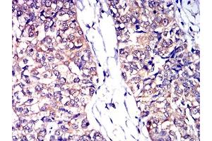 Immunohistochemical analysis of paraffin-embedded bladder cancer tissues using CD53 mouse mAb with DAB staining. (CD53 antibody)