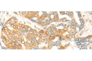 Immunohistochemistry of paraffin-embedded Human liver cancer tissue using CFHR2 Polyclonal Antibody at dilution of 1:35(x200) (CFHR2 antibody)