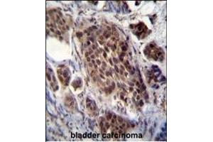 FRAT2 Antibody (C-term) (ABIN655793 and ABIN2845223) immunohistochemistry analysis in formalin fixed and paraffin embedded human bladder carcinoma followed by peroxidase conjugation of the secondary antibody and DAB staining. (FRAT2 antibody  (C-Term))