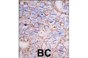 Formalin-fixed and paraffin-embedded human breast carcinoma tissue reacted with ERK8 antibody (N-term) (ABIN391796 and ABIN2841651) , which was peroxidase-conjugated to the secondary antibody, followed by DAB staining. (MAPK15 antibody  (N-Term))