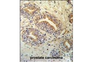 CWC15 Antibody (Center) (ABIN651004 and ABIN2840035) IHC analysis in formalin fixed and paraffin embedded prostate carcinoma followed by peroxidase conjugation of the secondary antibody and DAB staining. (CWC15 antibody  (AA 123-152))