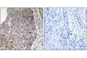 Immunohistochemistry analysis of paraffin-embedded human lung carcinoma tissue, using NEK7 Antibody. (NEK7 antibody  (AA 101-150))