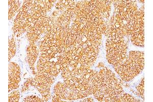 Formalin-fixed, paraffin-embedded human Renal Cell Carcinoma stained with RCC Monoclonal Antibody (SPM314). (CA9 antibody)