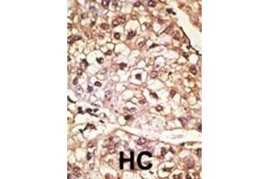 Formalin-fixed and paraffin-embedded human cancer tissue reacted with the primary antibody, which was peroxidase-conjugated to the secondary antibody, followed by AEC staining.