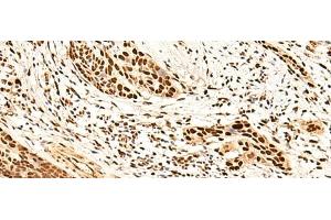 Immunohistochemistry of paraffin-embedded Human esophagus cancer tissue using METTL1 Polyclonal Antibody at dilution of 1:50(x200)