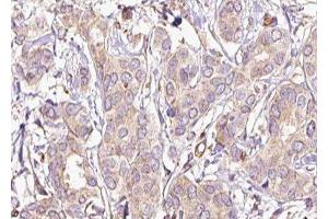 ABIN6277438 at 1/100 staining Human breast cancer tissue by IHC-P. (TPM2 antibody  (C-Term))
