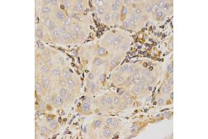 Immunohistochemistry of paraffin-embedded human liver cancer using KLK5 antibody (ABIN5971539) at dilution of 1/200 (40x lens). (Kallikrein 5 antibody)