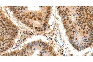 Immunohistochemistry of paraffin-embedded Human colon cancer tissue using SSB Polyclonal Antibody at dilution 1:50 (SSB antibody)