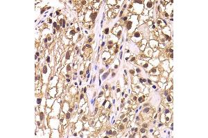 Immunohistochemistry of paraffin-embedded human kidney cancer using TCEB3 antibody.