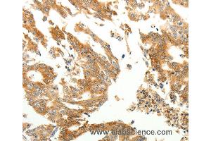 Immunohistochemistry of Human gastric cancer using RARRES1 Polyclonal Antibody at dilution of 1:60 (RARRES1 antibody)