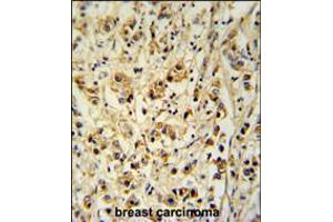 SMAGP Antibody immunohistochemistry analysis in formalin fixed and paraffin embedded human breast carcinoma followed by peroxidase conjugation of the secondary antibody and DAB staining. (SMAGP antibody  (AA 46-75))