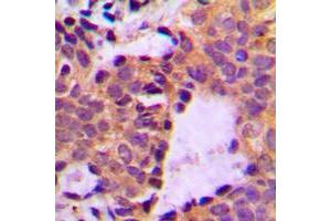 Immunohistochemical analysis of Cortactin (pY466) staining in human breast cancer formalin fixed paraffin embedded tissue section. (Cortactin antibody  (C-Term, pTyr466))