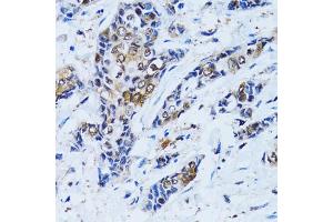 Immunohistochemistry of paraffin-embedded human breast cancer using IMPA1 antibody (ABIN2563424) at dilution of 1:100 (40x lens). (IMPA1 antibody)