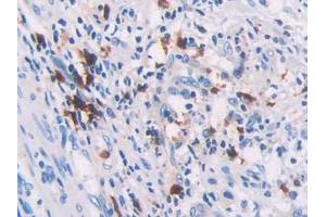 DAB staining on IHC-P; Samples: Human Colorectal cancer Tissue (RHOQ antibody  (AA 1-202))