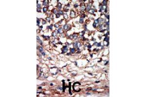 Formalin-fixed and paraffin-embedded human hepatocellular carcinoma tissue reacted with NEK9 polyclonal antibody  , which was peroxidase-conjugated to the secondary antibody, followed by AEC staining. (NEK9 antibody  (C-Term))