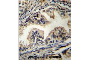 STBP Antibody (C-term) (ABIN656627 and ABIN2845873) immunohistochemistry analysis in formalin fixed and paraffin embedded human prostate carcinoma followed by peroxidase conjugation of the secondary antibody and DAB staining. (STAMBP antibody  (C-Term))