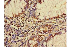 Immunohistochemistry of paraffin-embedded human colon cancer using ABIN7152491 at dilution of 1:100 (FBXW12 antibody  (AA 1-250))