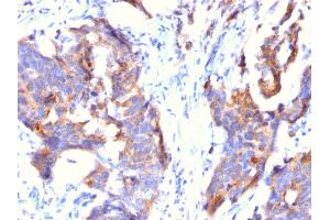 Formalin-fixed, paraffin-embedded human Stomach Carcinoma stained with MUC1 Mouse Monoclonal Antibody (115D8). (MUC1 antibody)