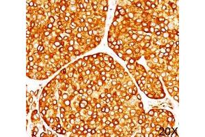 IHC staining of melanoma tissue (20X) with Tyrosinase antibody (T311). (TYR antibody)