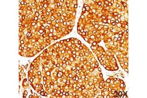 IHC staining of melanoma tissue (20X) with Tyrosinase antibody (T311). (TYR antibody)