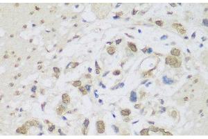 Immunohistochemistry of paraffin-embedded Human gastric cancer using DHX38 Polyclonal Antibody at dilution of 1:150 (40x lens). (DHX38 antibody)