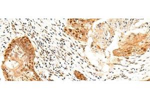 Immunohistochemistry of paraffin-embedded Human esophagus cancer tissue using SETMAR Polyclonal Antibody at dilution of 1:60(x200) (SETMAR antibody)