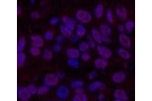 Immunofluorescence analysis of Human lung cancer tissue using Transferrin Monoclonal Antibody at dilution of 1:200. (Transferrin antibody)