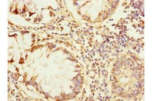 Immunohistochemistry of paraffin-embedded human colon cancer using ABIN7176726 at dilution of 1:100 (ZP2 antibody  (AA 651-745))