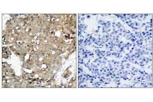 Immunohistochemical analysis of paraffin-embedded human breast carcinoma tissue using STAT1 (Ab-727) antibody (E021177). (STAT1 antibody)