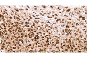 Immunohistochemistry of paraffin-embedded Human esophagus cancer using PARP1 Polyclonal Antibody at dilution of 1:40 (PARP1 antibody)
