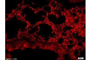 Formalin-fixed and paraffin embedded human colon carcinoma labeled with Anti-CD24 Polyclonal Antibody, Unconjugated (ABIN669681) at 1:200, followed by conjugation to the secondary antibody (CD24 antibody  (AA 60-80))