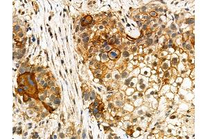 ABIN7093100 and ABIN7097254 at 1/100 staining Human ovarian cancer by IHC-P. (MLKL antibody  (pSer347))