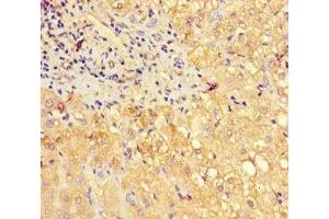 Immunohistochemistry of paraffin-embedded human liver cancer using ABIN7160703 at dilution of 1:100 (PGLYRP2 antibody  (AA 22-576))