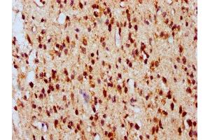 IHC image of ABIN7145109 diluted at 1:700 and staining in paraffin-embedded human glioma performed on a Leica BondTM system. (ATG16L2 antibody  (AA 262-348))