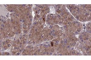 ABIN6273976 at 1/100 staining Human liver cancer tissue by IHC-P. (OR2A2 antibody  (Internal Region))