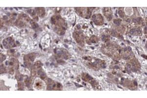 ABIN6273860 at 1/100 staining Human liver cancer tissue by IHC-P. (GPR20 antibody  (C-Term))