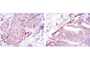 Immunohistochemical analysis of paraffin-embedded kidney cancer tissues (left) and stomach cancer tissues (right) using BMPR2 mouse mAb with DAB staining.