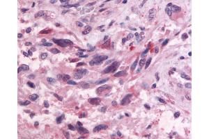 Anti-GPR83 antibody IHC of human Brain, Glioblastoma. (GPR83 antibody  (Cytoplasmic Domain))