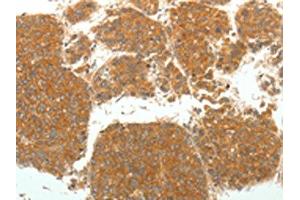 The image on the left is immunohistochemistry of paraffin-embedded Human liver cancer tissue using ABIN7131067(SIRT4 Antibody) at dilution 1/25. (SIRT4 antibody)