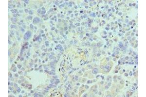 Immunohistochemistry of paraffin-embedded human lung cancer using ABIN7143847 at dilution of 1:100