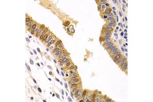 Immunohistochemistry of paraffin-embedded human uterine cancer using CXCR3 Antibody (ABIN5971514) at dilution of 1/200 (40x lens). (CXCR3 antibody)